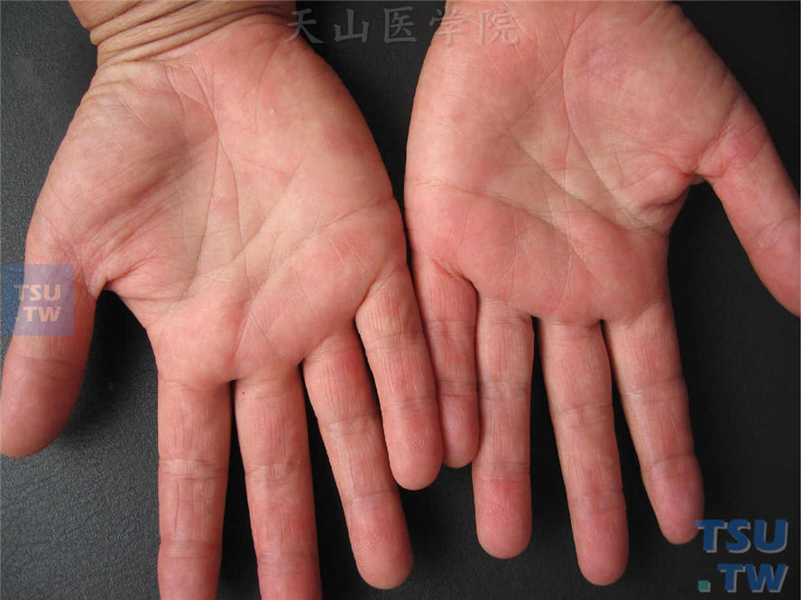 红斑性肢痛病：局部温度升高后发生手部水肿性斑丘疹，伴有刺痒感