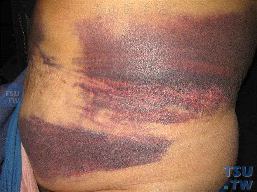爆发性紫癜：病史5天，突然发生大面积皮肤出血，进展较快，血小板正常，尿蛋白（+）