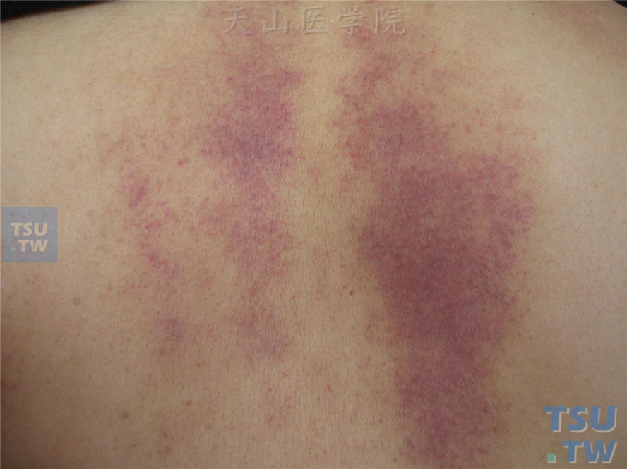 外伤性紫癜（traumatic purpura）症状表现