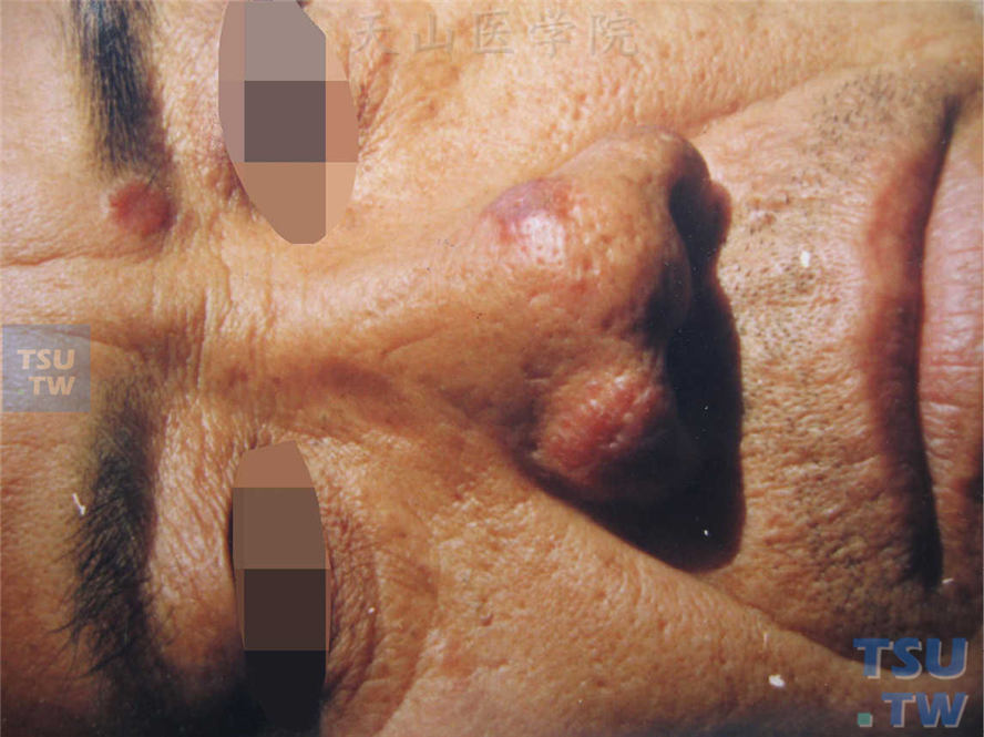 面部黄豆至扁豆大小棕红色浸润性斑丘疹，眉部皮损中央略萎缩