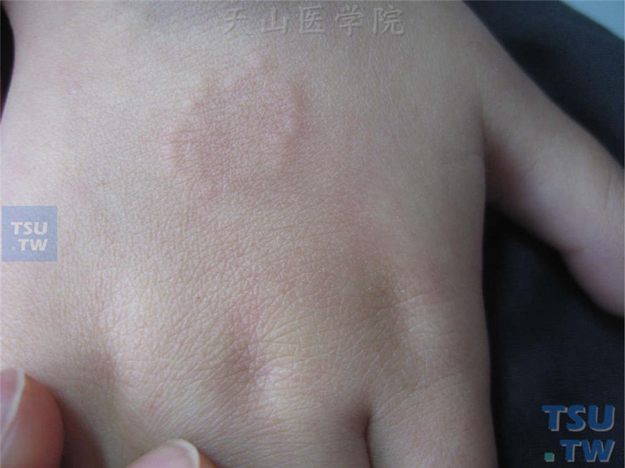 手背环状损害，边缘由正常皮色小的光滑硬质丘疹组成