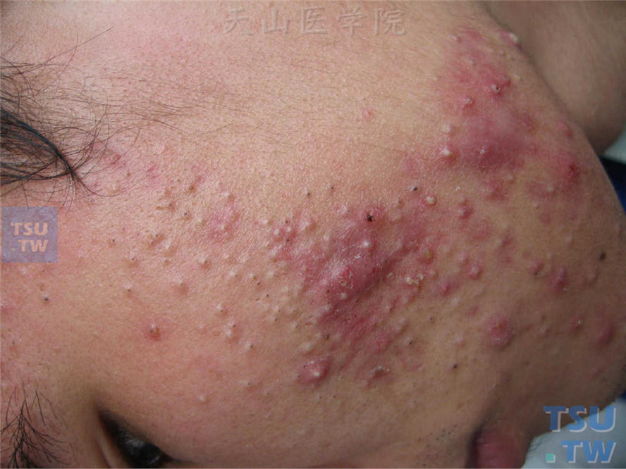 痤疮：面部除黑头、白头粉刺外，尚可见炎性丘疹、丘脓疱疹