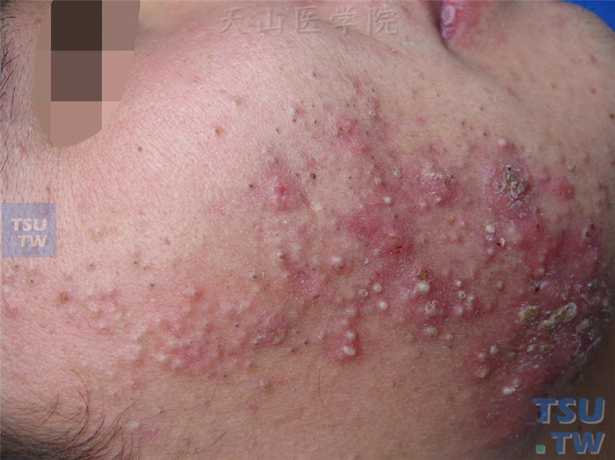 痤疮：面颊、下颌密集黑头、白头粉刺、炎性丘疹、丘脓疱疹，下颌处可见炎性囊肿，压之有波动感