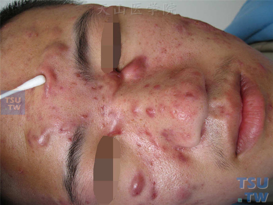 痤疮：面部大小不一囊肿，挤压有弹性或有波动感，散在黑头粉刺、炎性丘疹及萎缩性瘢痕