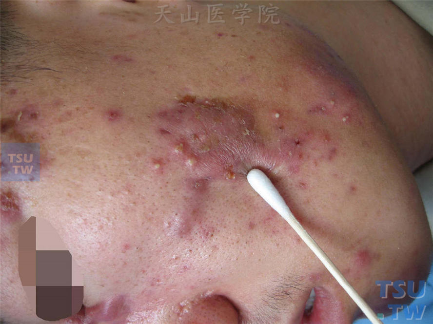 痤疮（acne）症状表现