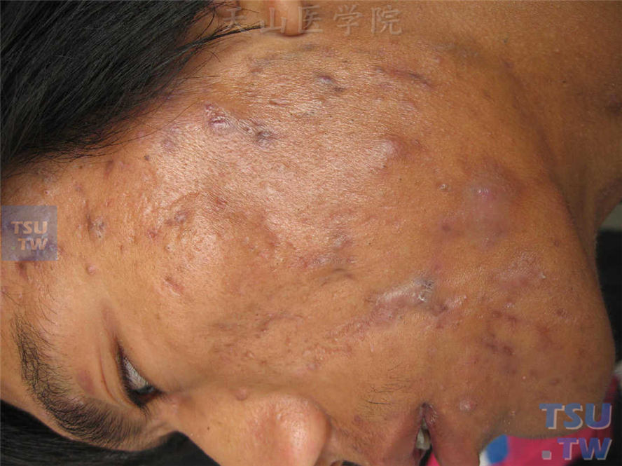 痤疮：面部粉刺、炎性丘疹、囊肿、瘢痕