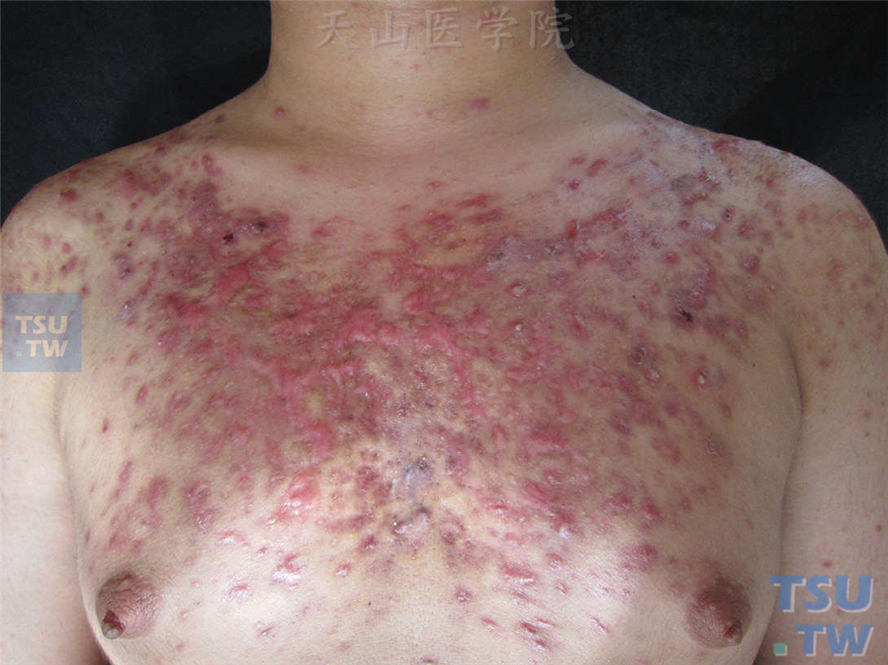 痤疮：同一病人，前胸部增生性瘢痕，其间散在丘脓疱疹
