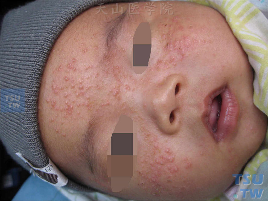 痤疮：新生儿痤疮：面部密集粉刺、丘疹、丘脓疱疹