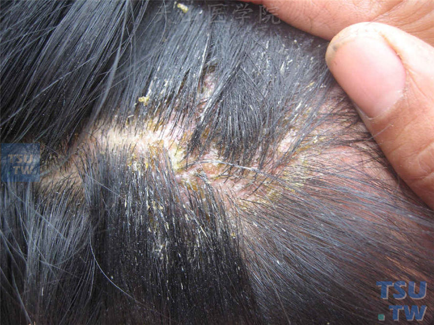 脂溢性湿疹：头皮部位红斑、糜烂、渗出、结痂、脱屑