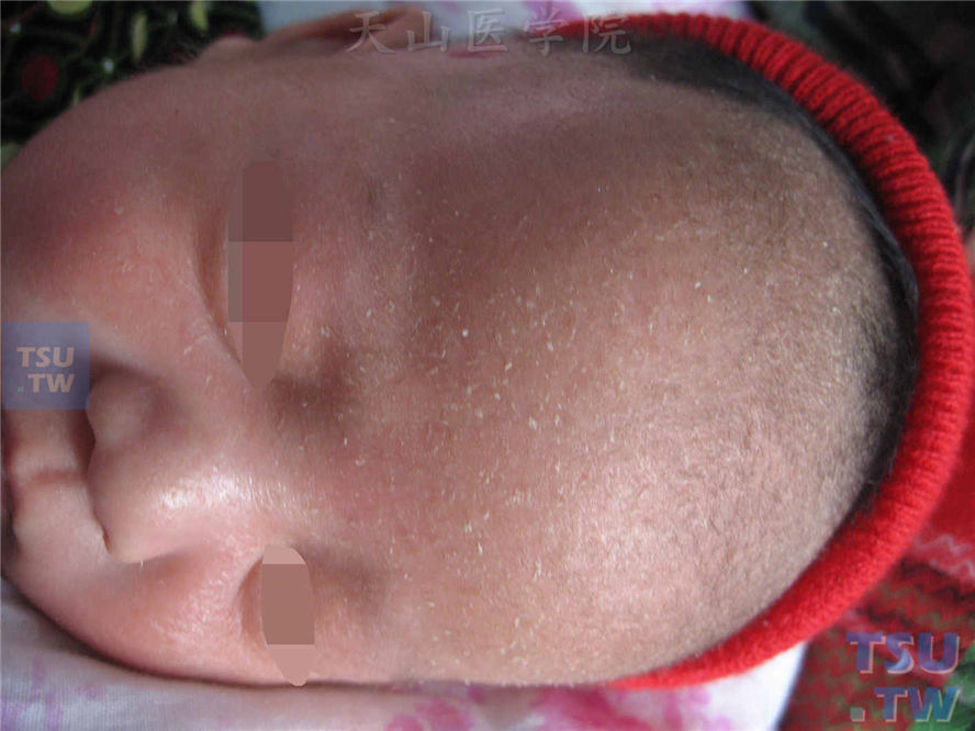 婴儿脂溢性皮炎（infantile seborrheic dermatitis）：额部、眉毛部位弥漫被覆油腻性灰白细碎薄层鳞屑