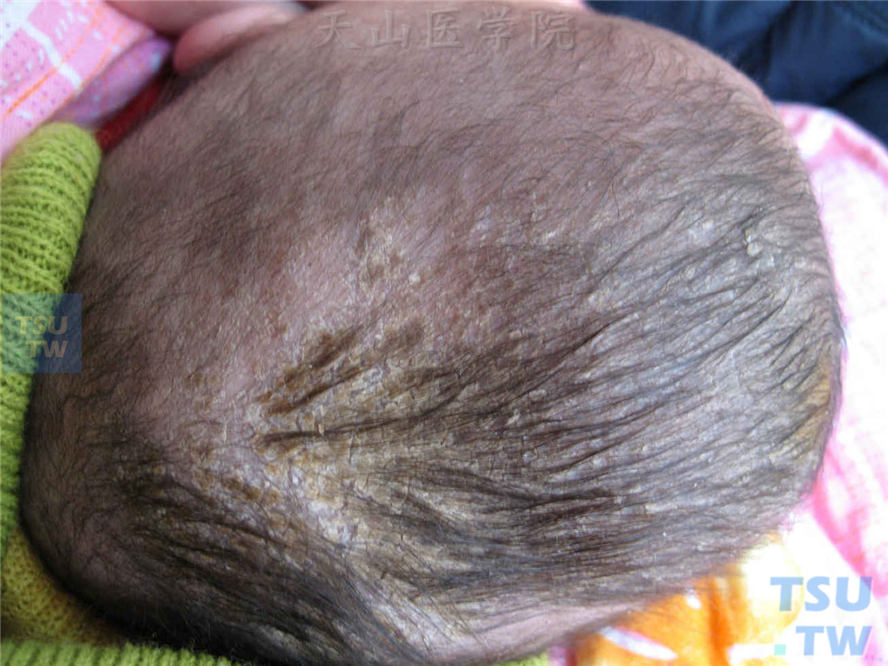 同一患儿，头皮被覆厚薄不等的灰黄色或黄褐色痂屑