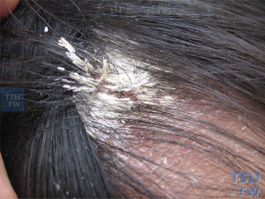 毛发鞘：毛发近端包绕以白色鞘状物，酷似石棉结晶