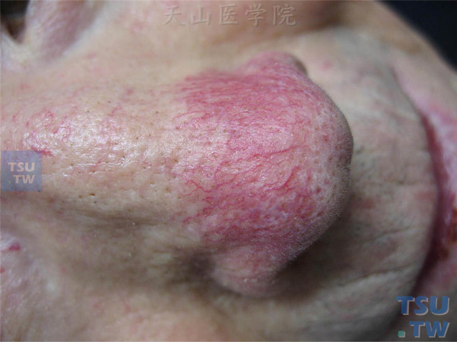 红斑期：鼻部树枝状分布的毛细血扩张