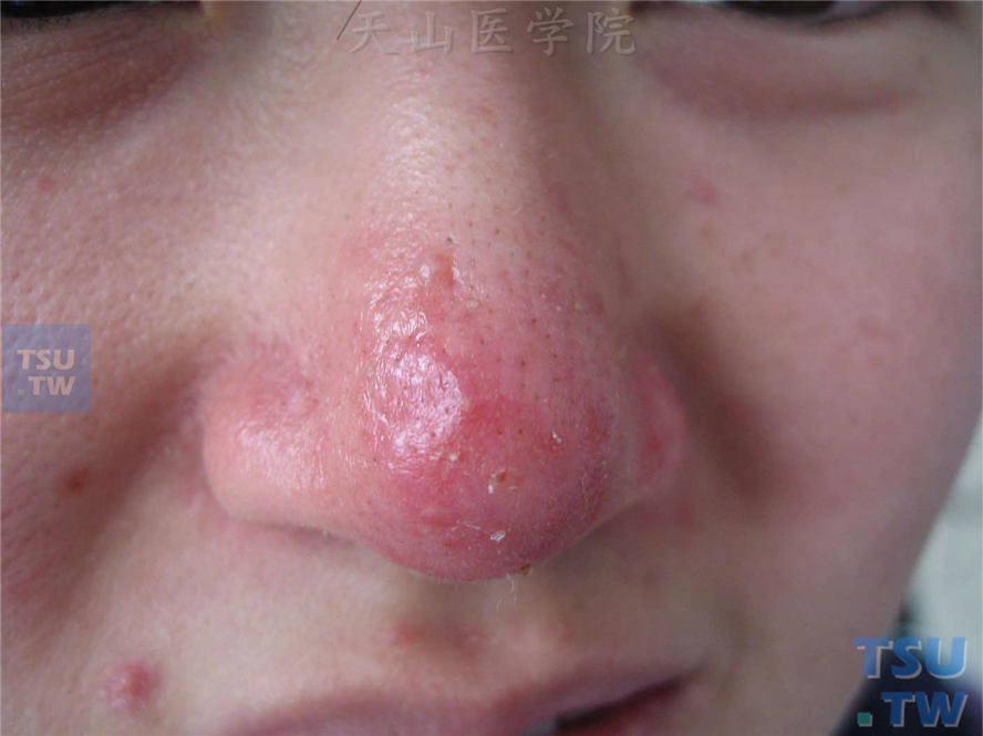 丘疹脓疱期：红斑基础上发生丘疹、丘脓疱疹