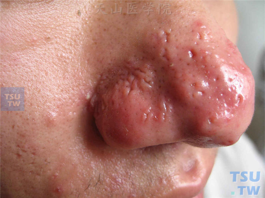 鼻赘期：鼻部大小不等紫红色鼻赘，毛囊口显著扩张，皮脂分泌旺盛