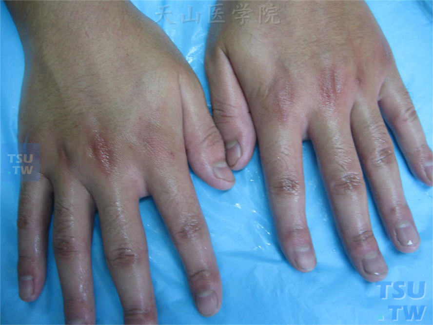 同一病人，手背及手指背侧皮肤表面大量汗液