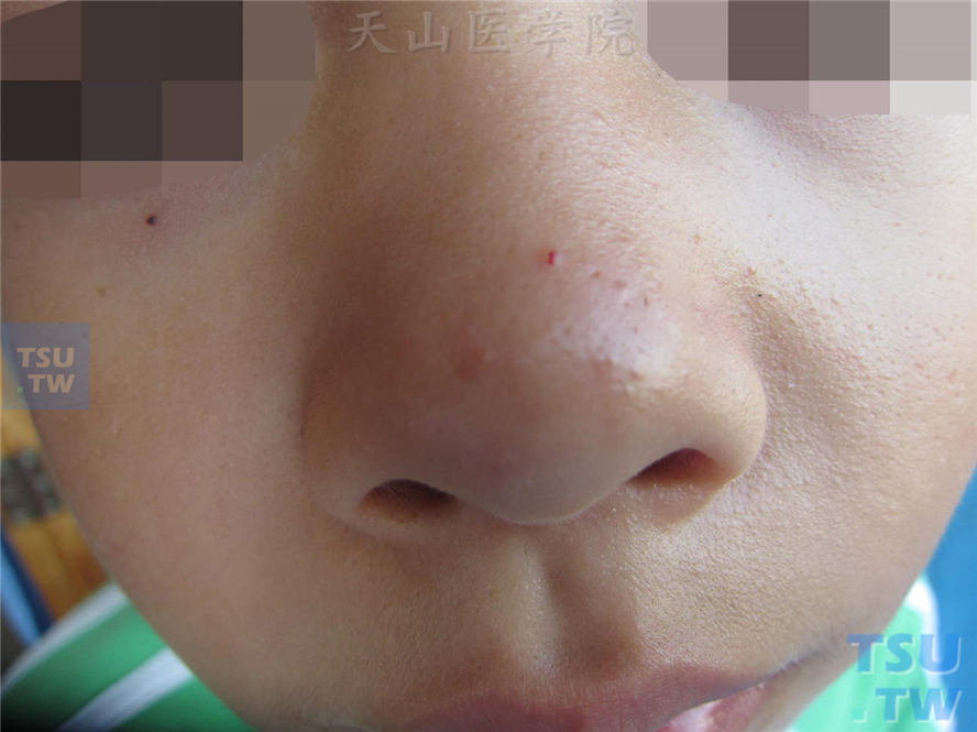 鼻头部位红色丘疹，散在分布