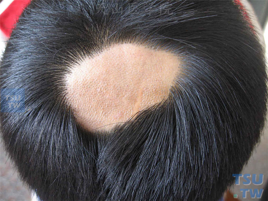 头皮片状脱发，边界清楚，头皮光滑，无炎症、鳞屑、瘢痕、萎缩等损害