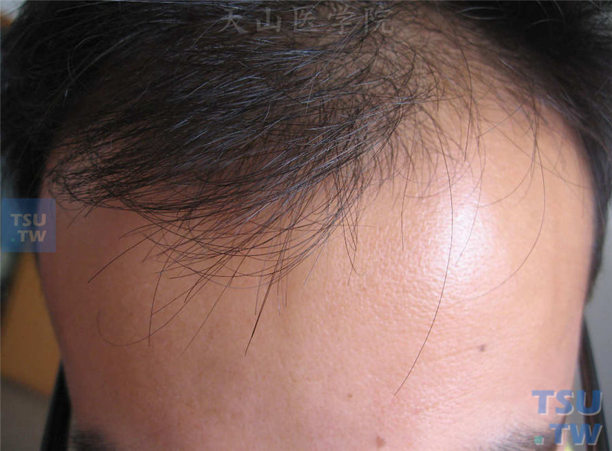 雄性激素源性脱发（androgenetic alopecia）症状表现