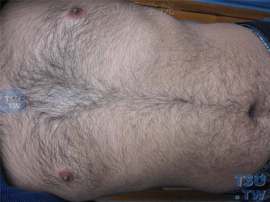 先天性毛增多症：前胸、腹部体毛增多、增粗