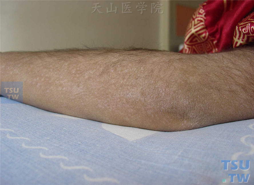 医源性毛增多症（iatrogenic hypertrichosis）