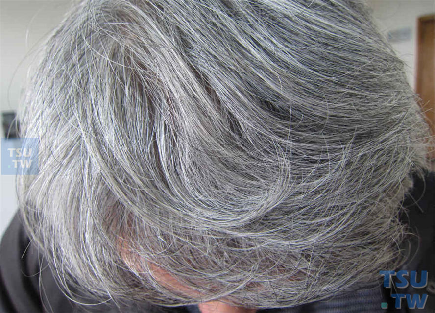 病人头发完全变成灰白色