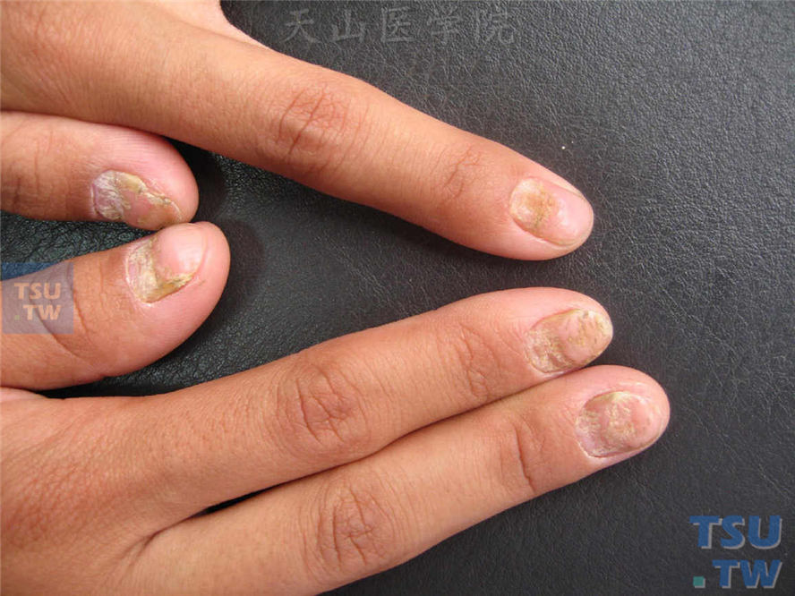 甲营养不良（nail dystrophy）症状表现