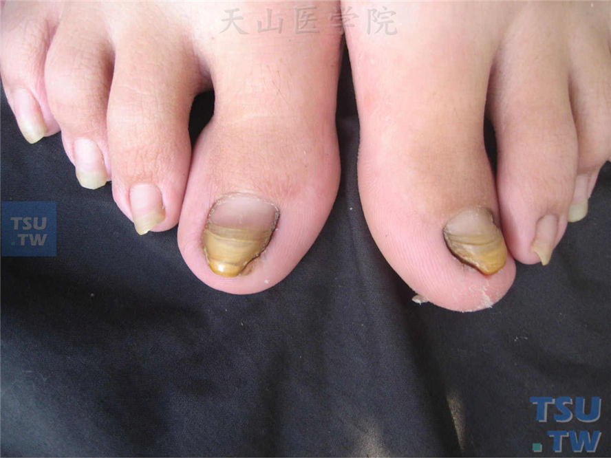 黄甲（yellow nails）症状表现