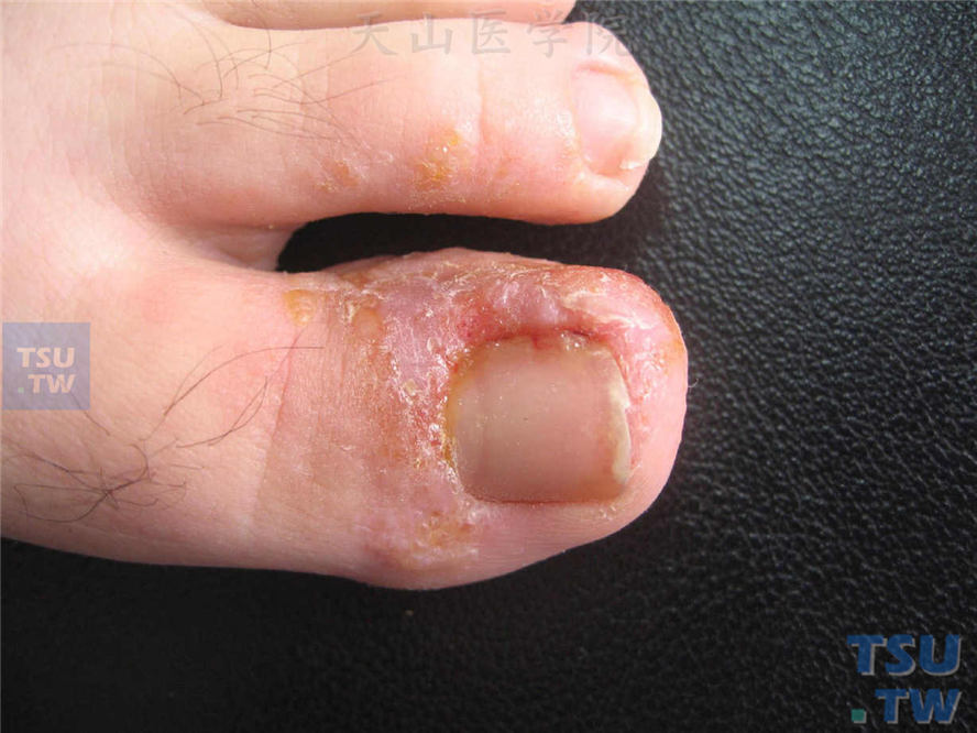 嵌甲（ingrowing nail）症状表现