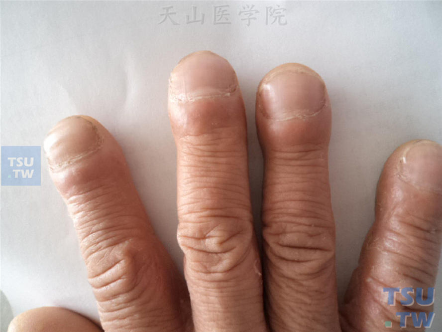 患者手指末端肥大，呈鼓槌状，甲板也明显增大，弯曲似球状面