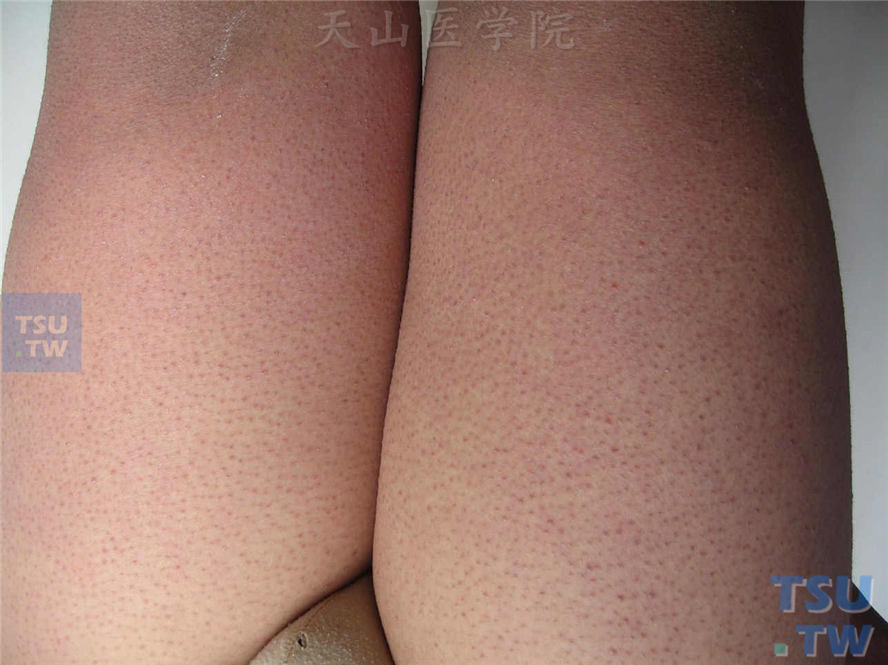大腿伸侧与毛孔一致的角化性丘疹，触之有粗糙感