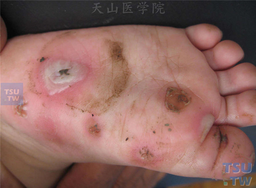 大疱性表皮松解症：足底摩擦部位发生水疱、大疱