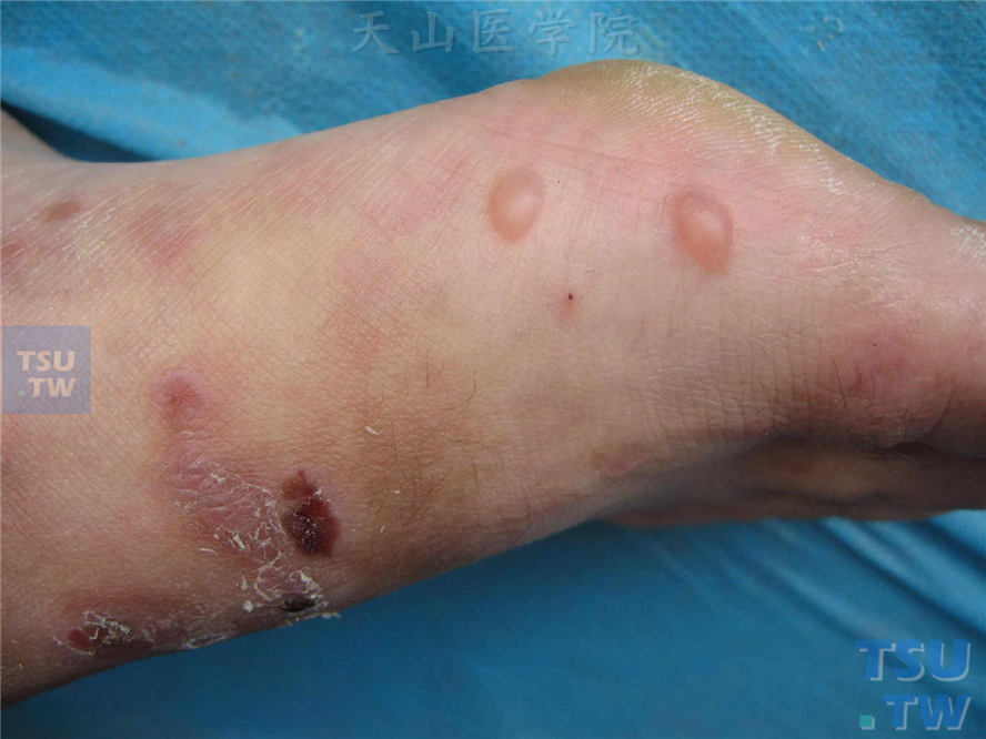 大疱性表皮松解症：其母足部侧缘水疱