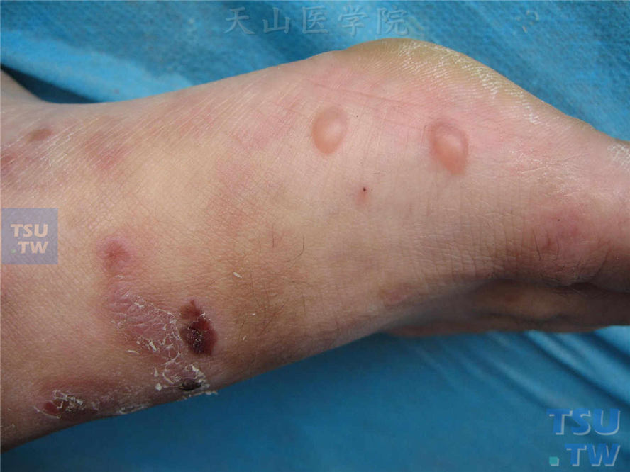 大疱性表皮松解症（epidermolysis bullosa）症状表现