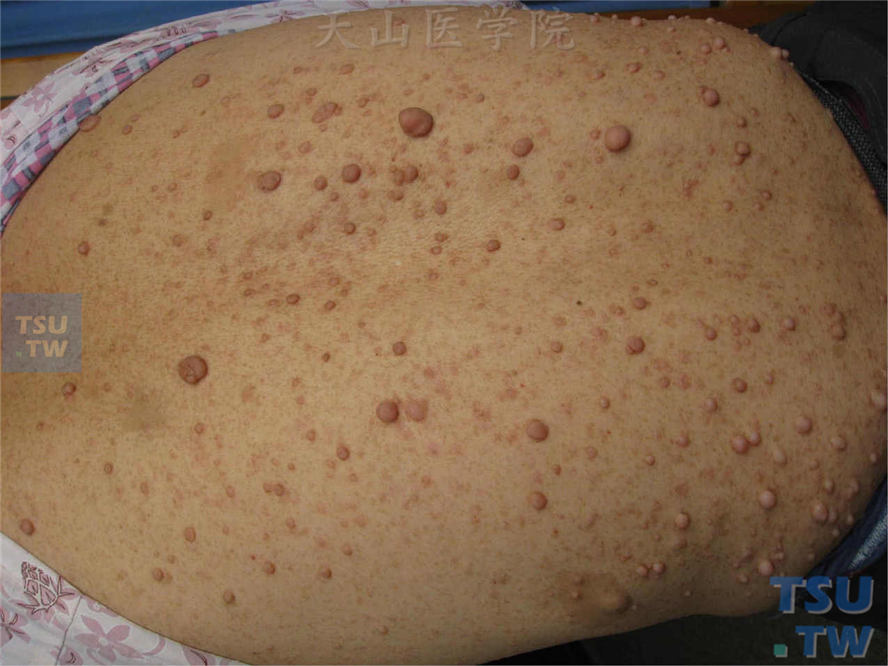 后背部广泛大小不等正常皮色或淡红色软的肿物