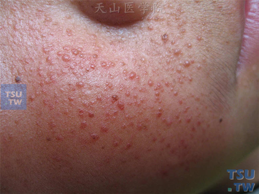 结节性硬化症（tuberous sclerosis）症状表现