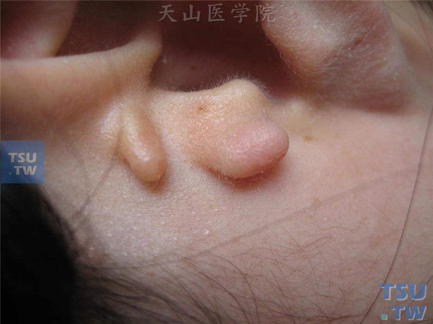 副耳（accessory auricles）耳屏前小结节