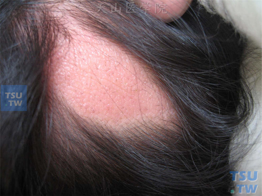 头皮长形皮肤缺损，自幼发生，表面光滑，边界清楚，略低于周围皮肤