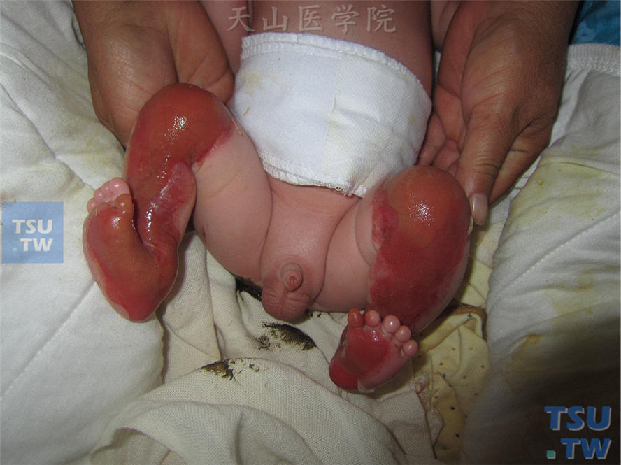 患儿出生后发现双下肢皮肤缺损，边界清楚，皮损处略低于周围皮肤
