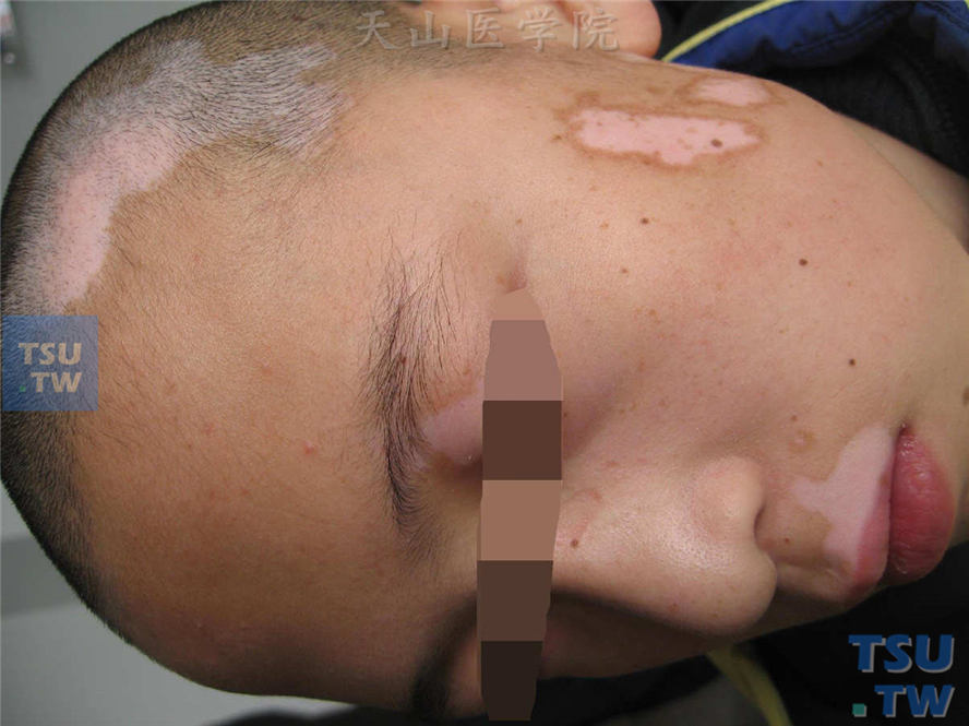 白癜风症状表现：面部、头皮多发色素脱失斑，边缘色素加深