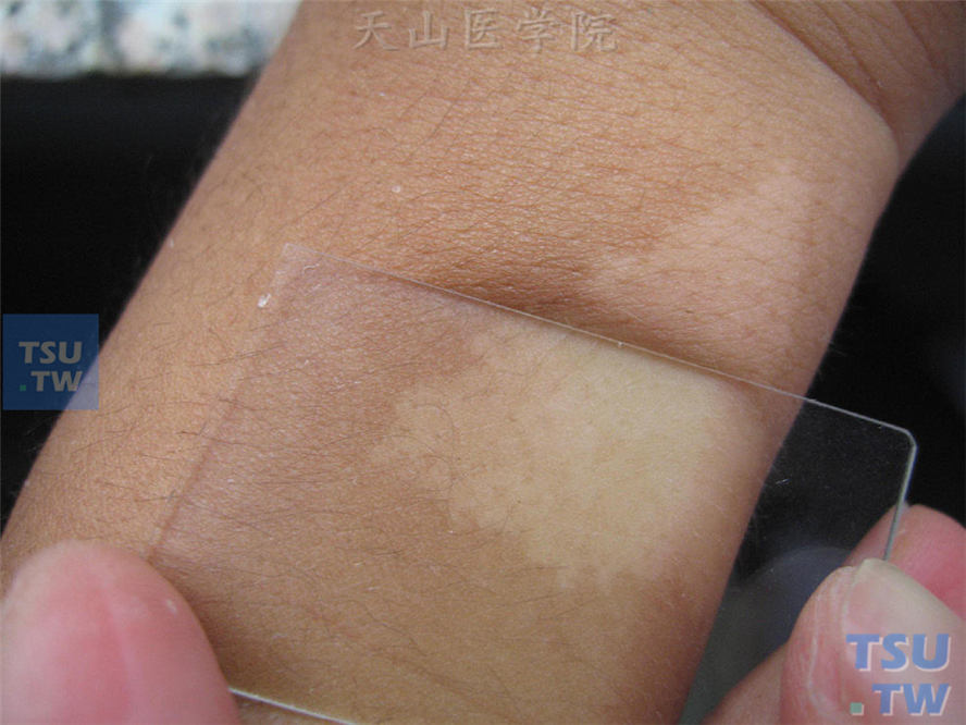 无色素痣（achromic nevus）症状表现