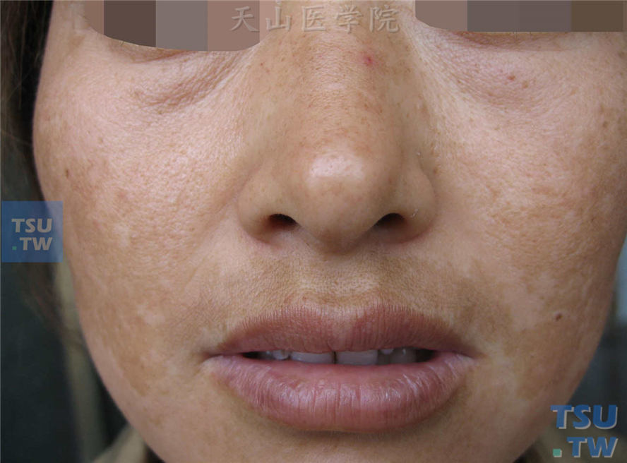 黄褐斑（melasma）症状表现