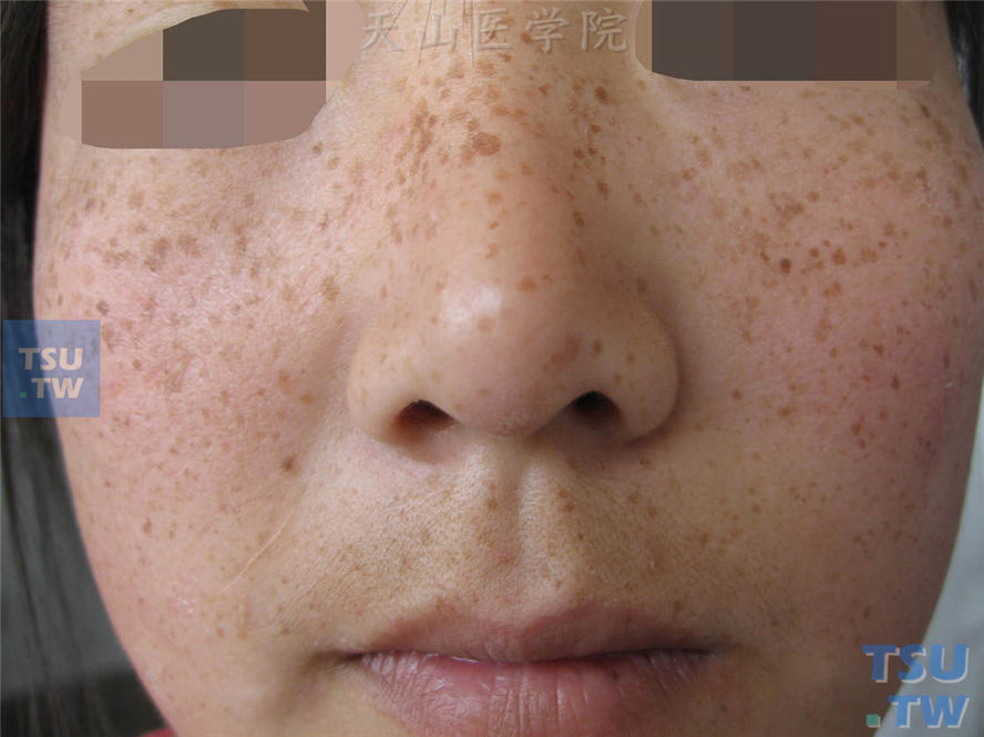 雀斑（freckle）症状表现