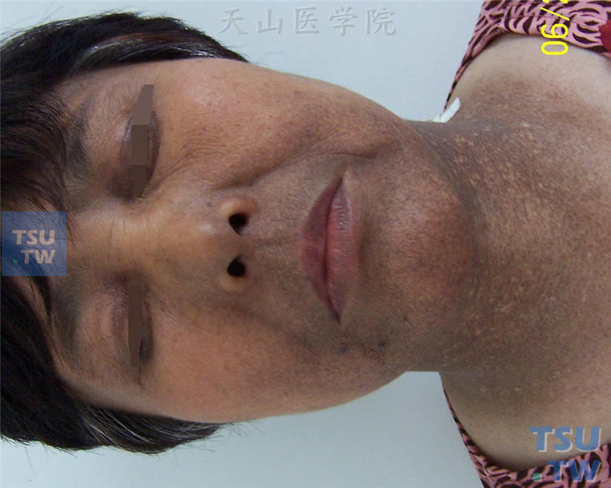 Riehl黑变病（riehl melanosis）症状表现