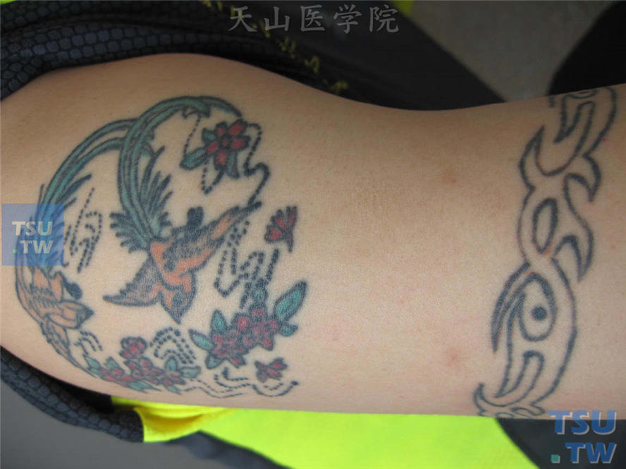 文身（tattoos）的皮肤表现