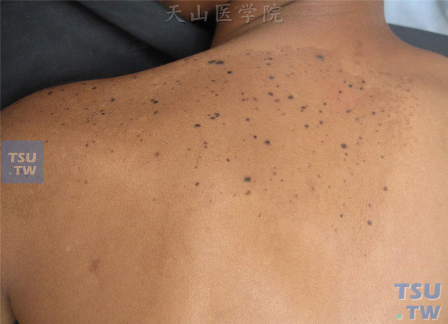 斑痣（nevus spilus）症状表现