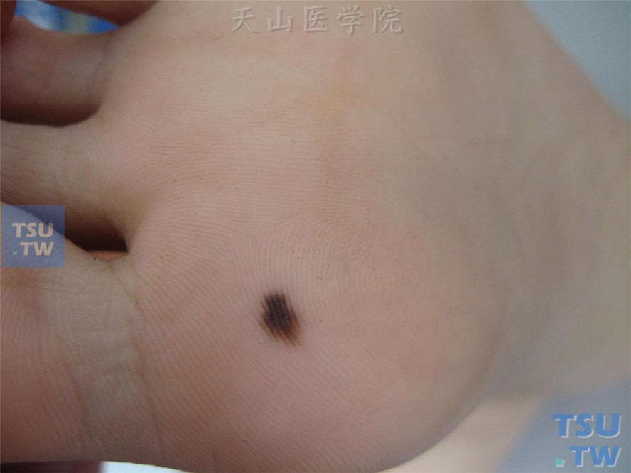 交界痣：足底褐色斑片，不高起皮肤，表面光滑无毛