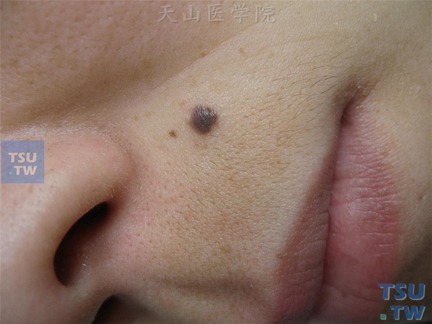 混合痣：褐黑色斑疹，表面略高起周围皮肤