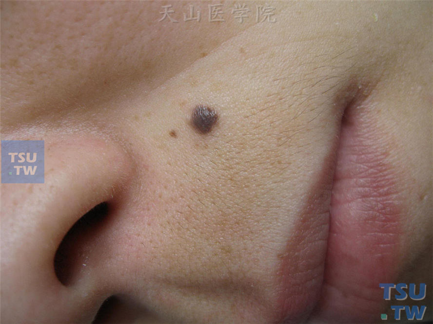 色痣（pigmented nevus）症状表现