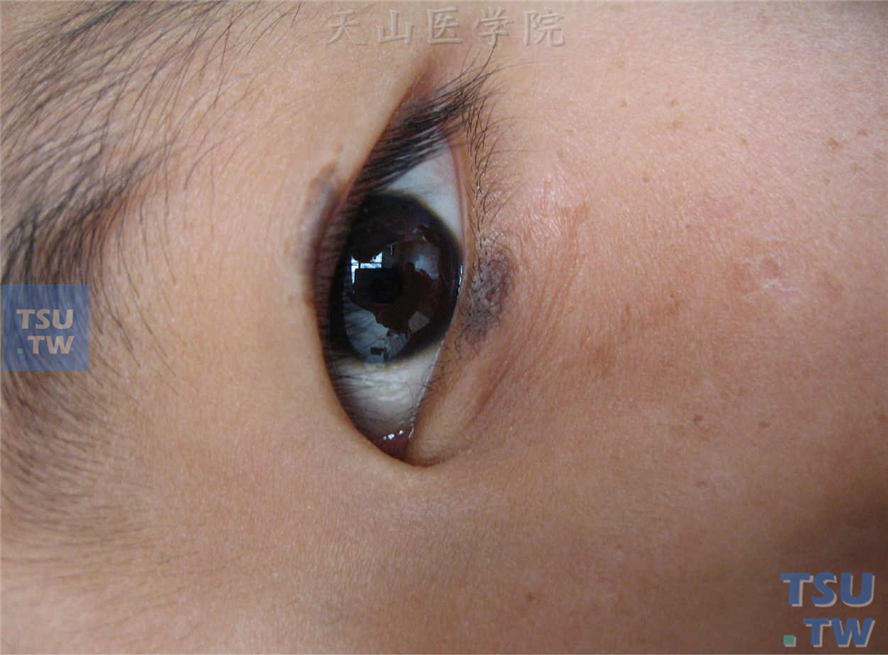 上下眼睑对应部位发生褐色斑片